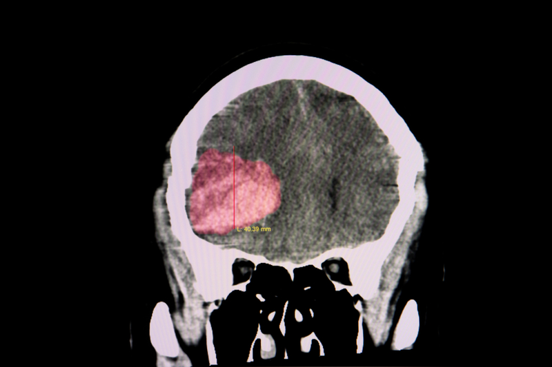 Blood Clot in Brain