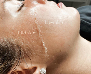 Dermaplaning