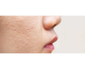 Platelet rich plasma