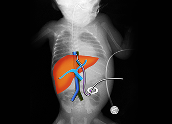 Umbilical Artery and Umbilical Vein Cannulation